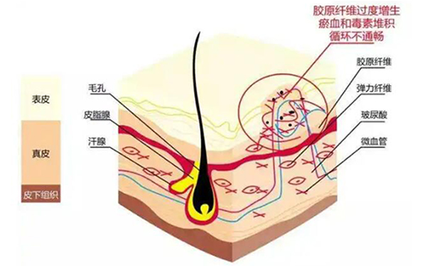 烧伤疤痕修复