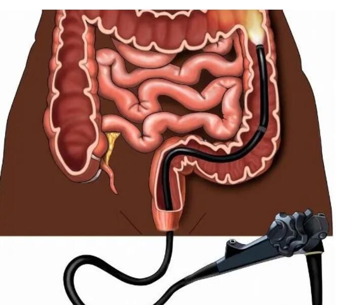 赤峰到底要不要做胃肠镜呢？